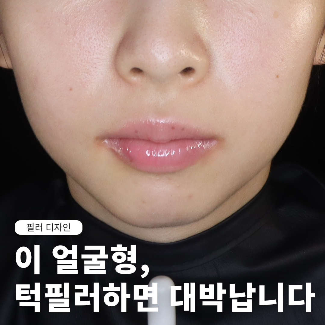 이 얼굴형, 턱필러하면 대박납니다