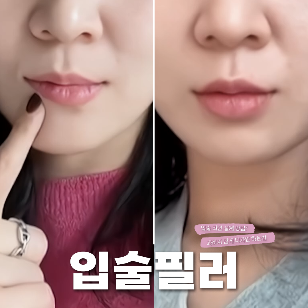 입술필러